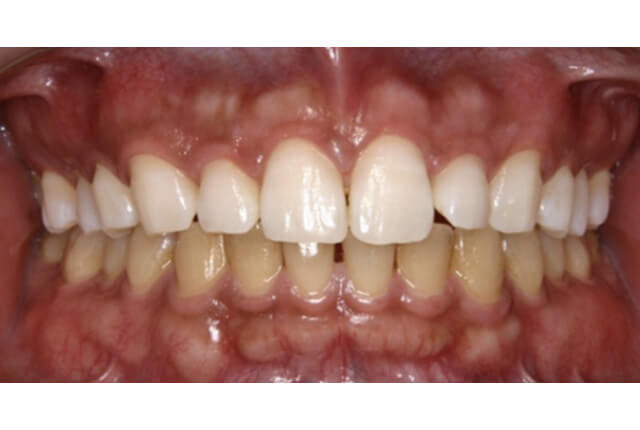 歯の黄ばみ（ホワイトニング）治療後