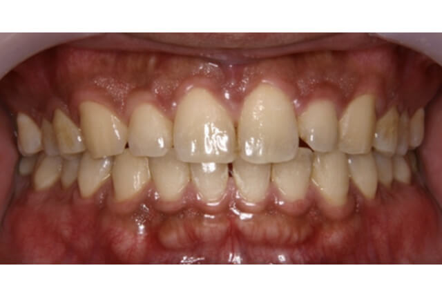 歯の黄ばみ（ホワイトニング）治療前